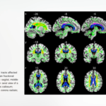 Obesity’s Impacts on Our Brain, Dementia, and Fertility 