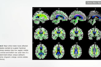 Obesity’s Impacts on Our Brain, Dementia, and Fertility 