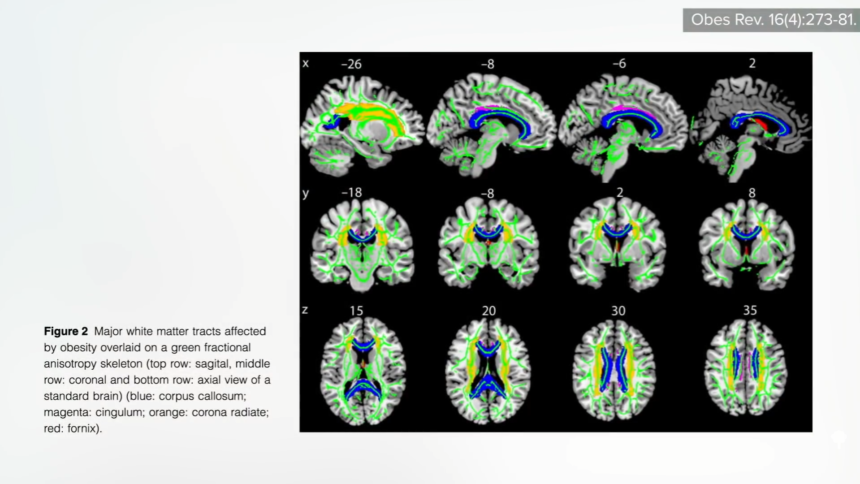 Obesity’s Impacts on Our Brain, Dementia, and Fertility 