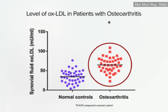 The Best Alternative to Knee Replacement for Osteoarthritis 